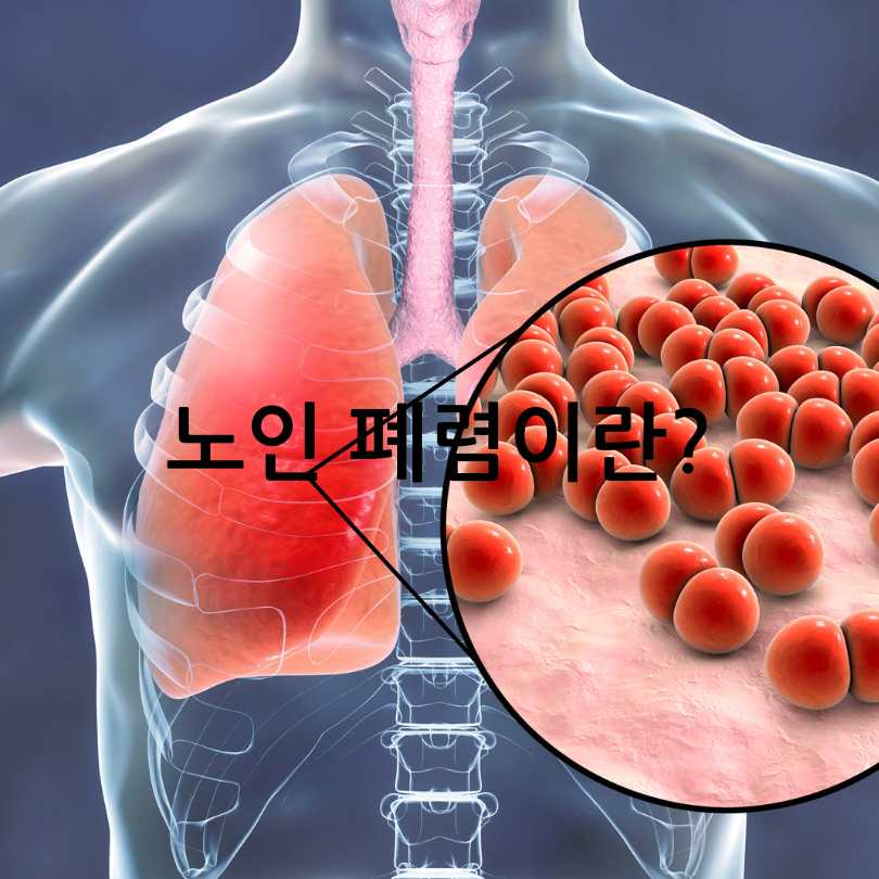 노인 폐렴 증상과 대처법