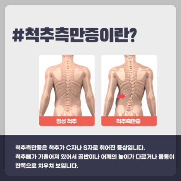 척추측만증