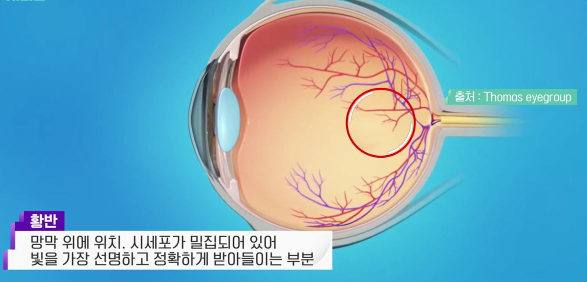 황반변성