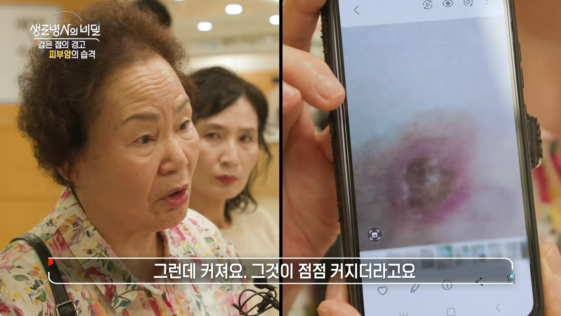 생로병사의 비밀 피부암 검은점