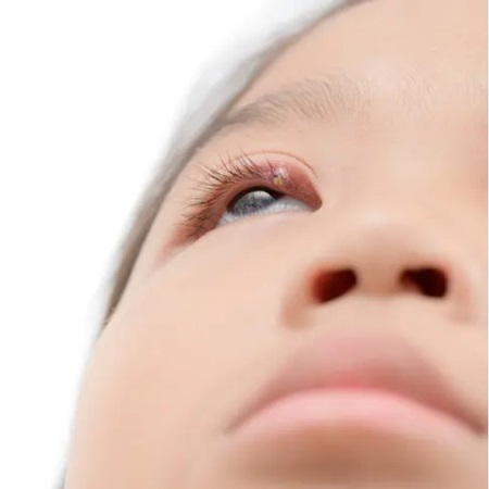 눈-다래끼-빨리-낫는법