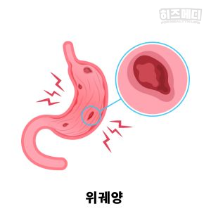 위축성 위염 증상 합병증