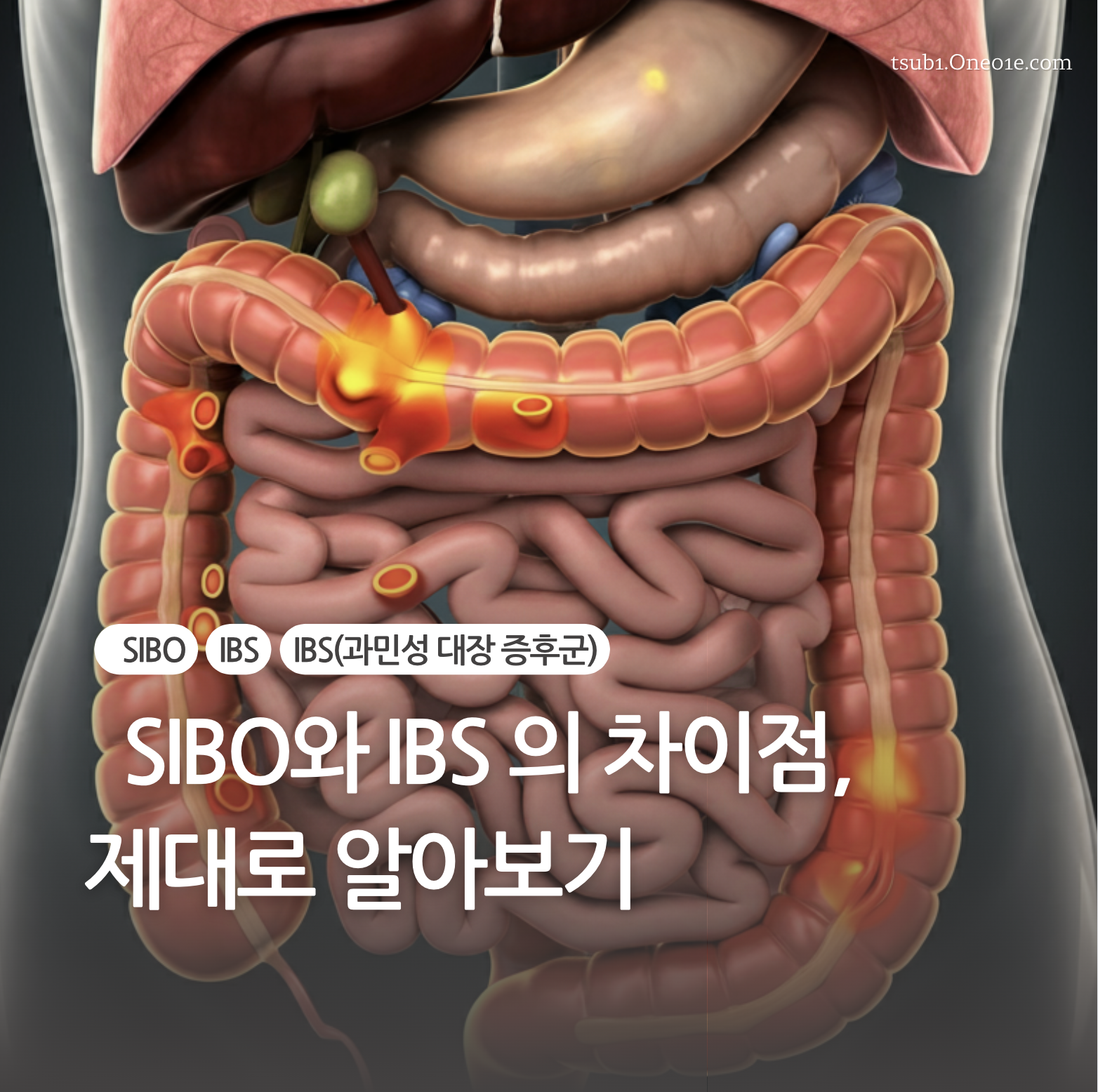 SIBO와 IBS의 차이점