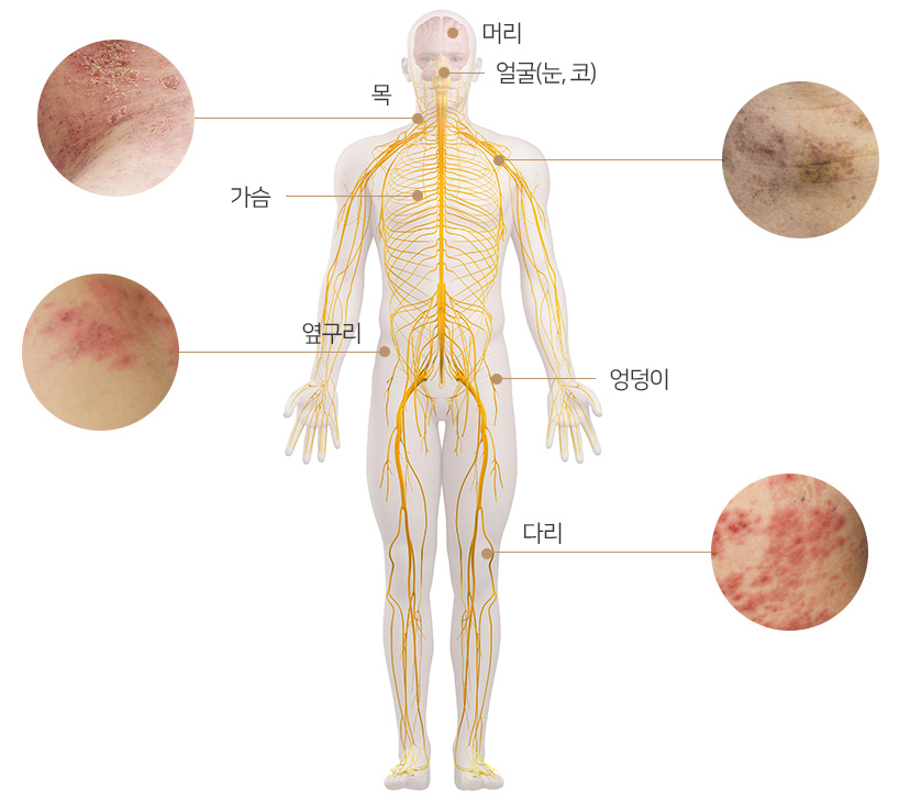 대상포진증상사진
