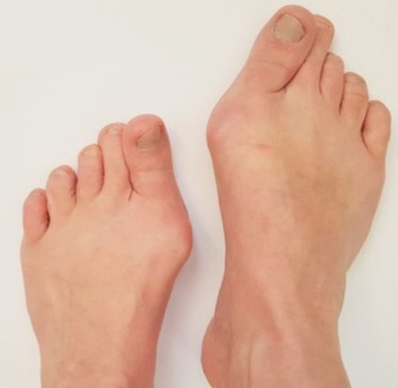 무지외반증이란?