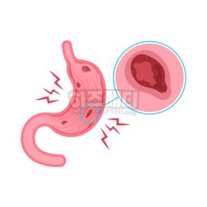 분변 잠혈검사 양성