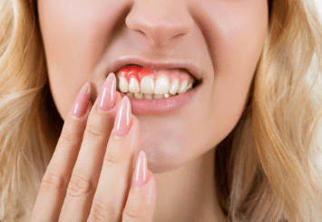 잇몸 염증 치료약