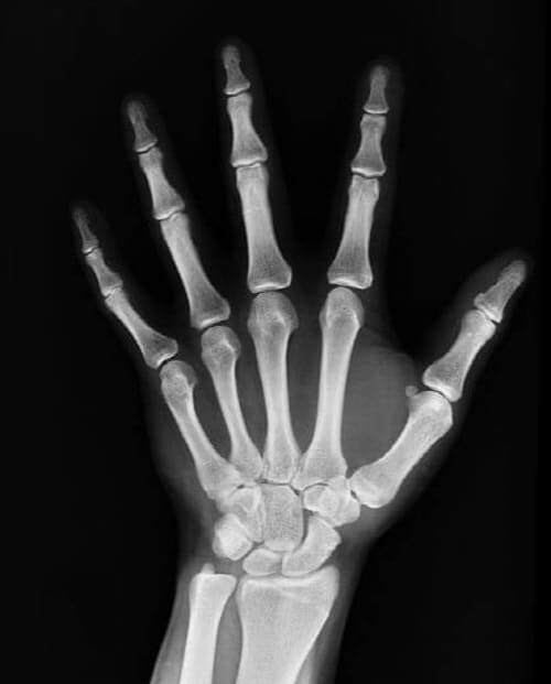 골절시-주의할점