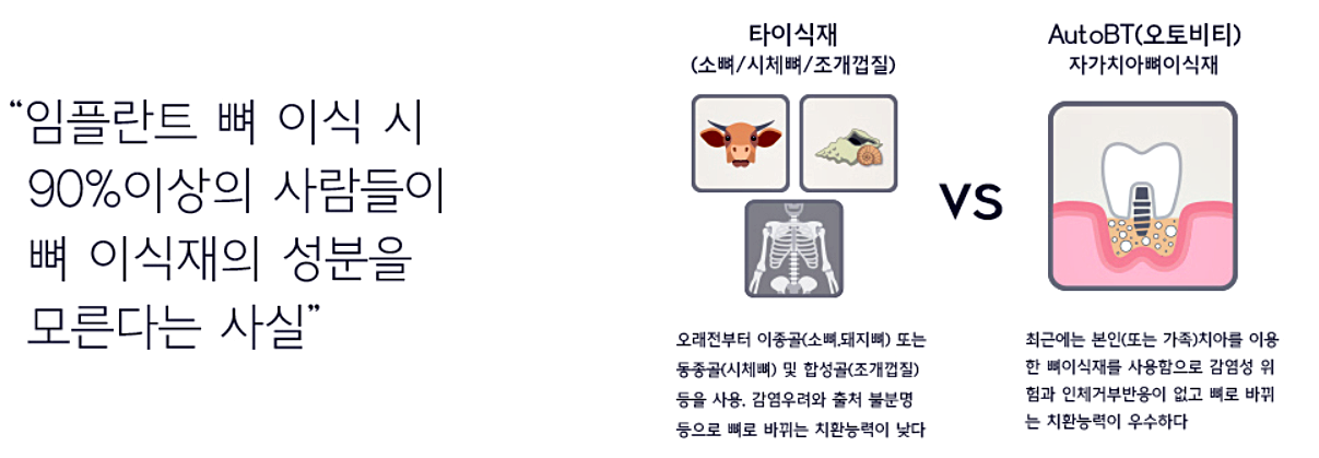 자가치아 뼈이식