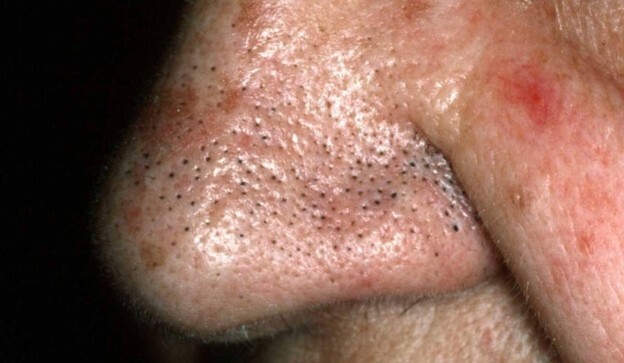 콧등에 주로 나타나는 소극성 속모증