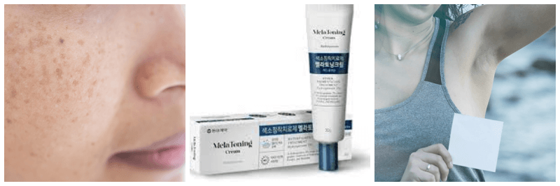 멜라토닝크림, 기미 주근깨, 겨드랑이 색소침착 사진