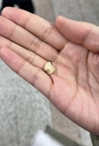 빠진-이빨을-손에-들고있는-남자