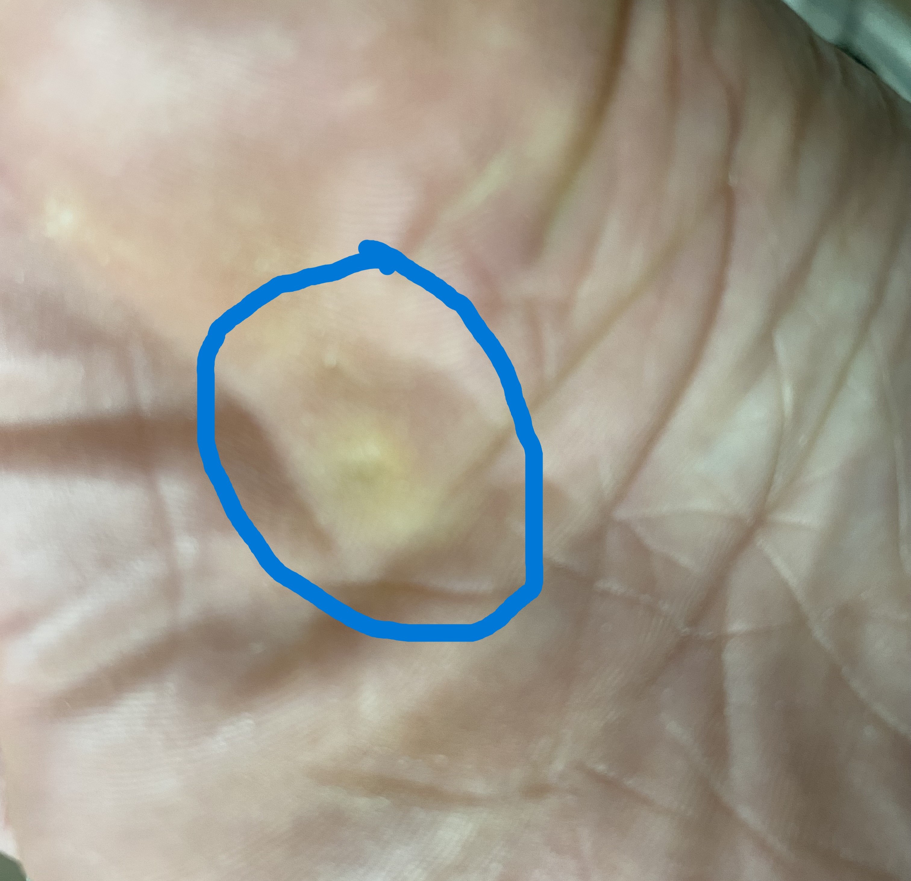 파란색 동그라미 부분이 티눈이에요.