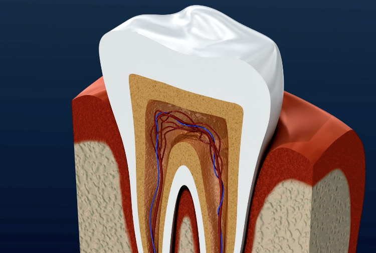 지르코니아 크라운