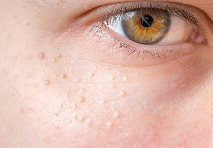 비립종 생기는 이유