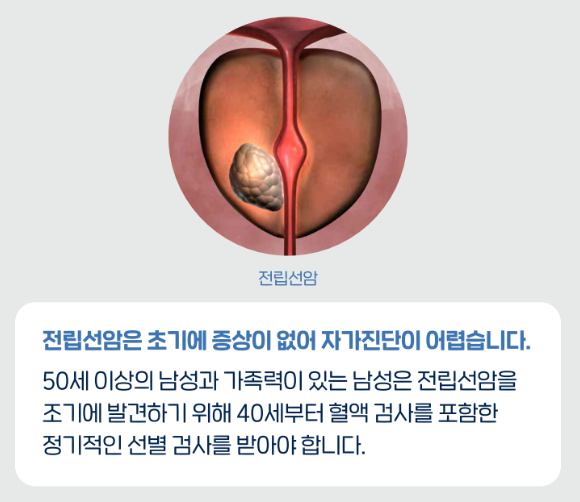 전립선암 초기증상 1