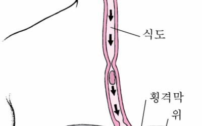 식도암이미지