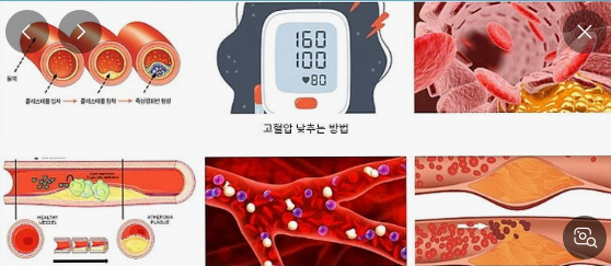 유전성 고혈압과 생활습관성 고혈압 관련사진