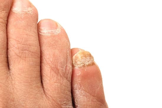 손발톱 백선(손발톱 무좀, 조갑 백선)