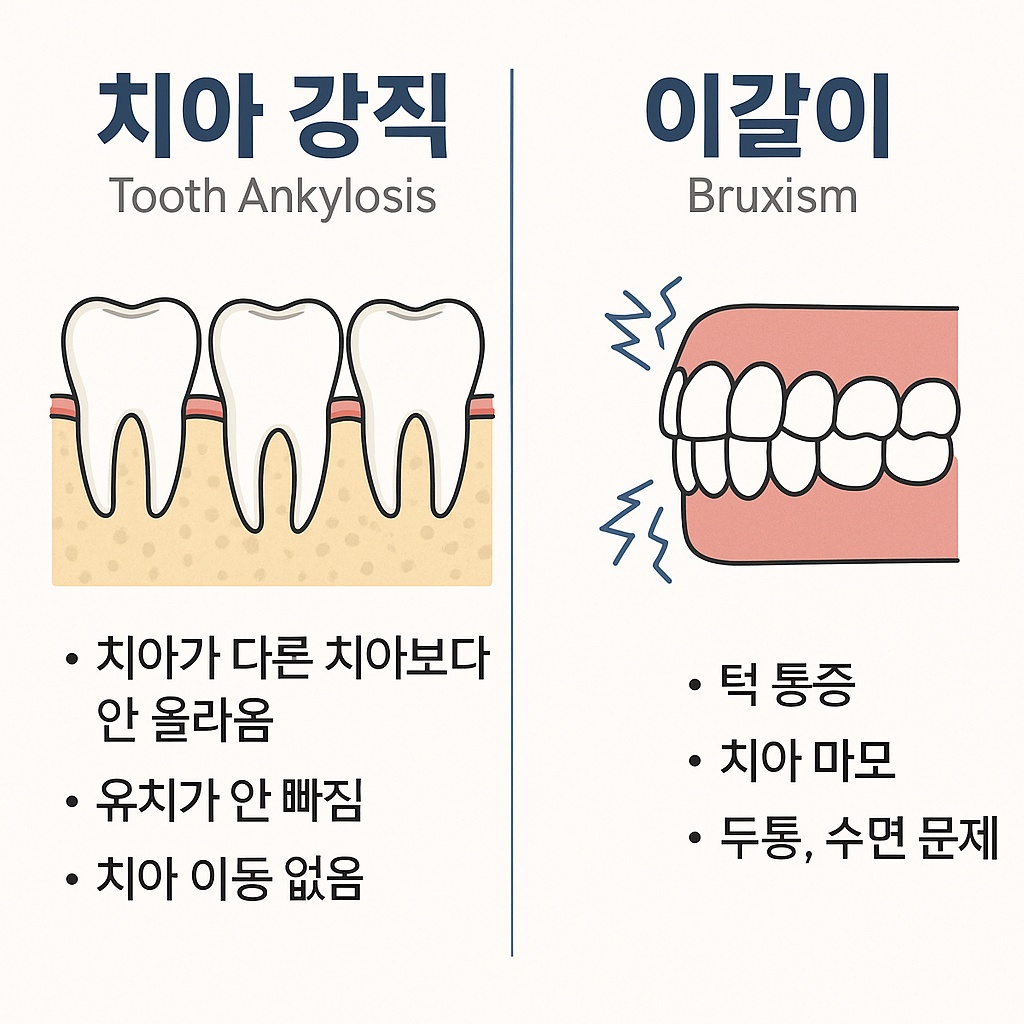 치아 강직 vs 이갈이 차이점 관련 이미지