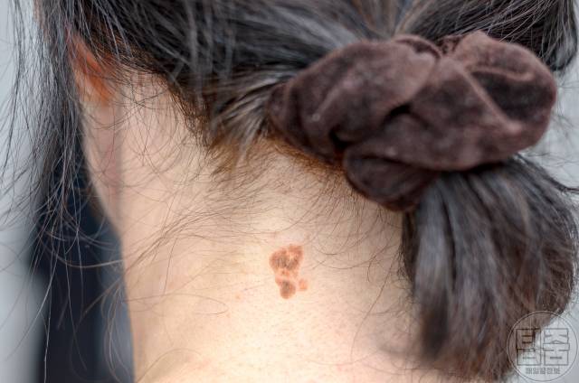 암 초기증상,피부암 증상