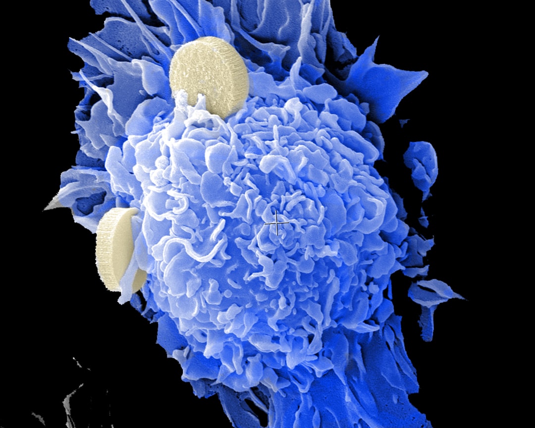 Pancreatic cancer.