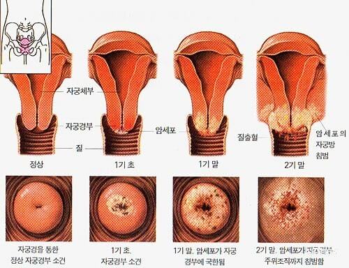 자궁경부암 경과 및 치료
