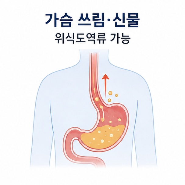 가슴 쓰림과 신물이 목으로 올라오는 증상이 위식도역류와 관련될 수 있음을 설명한 이미지