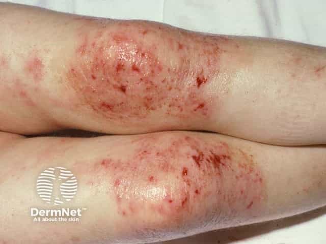 아토피&amp;#44; 단순 피부 트러블이라고 생각하셨나요?