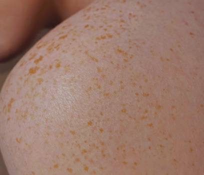 히알루론산 효능