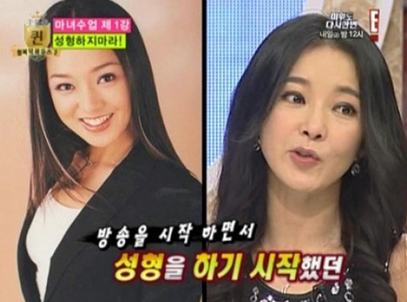 눈 성형 부작용