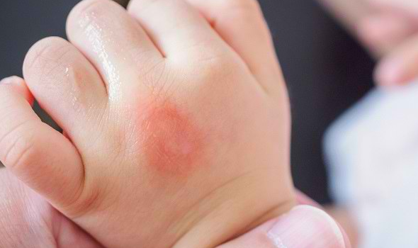 아기 손에 모기 물린 모양