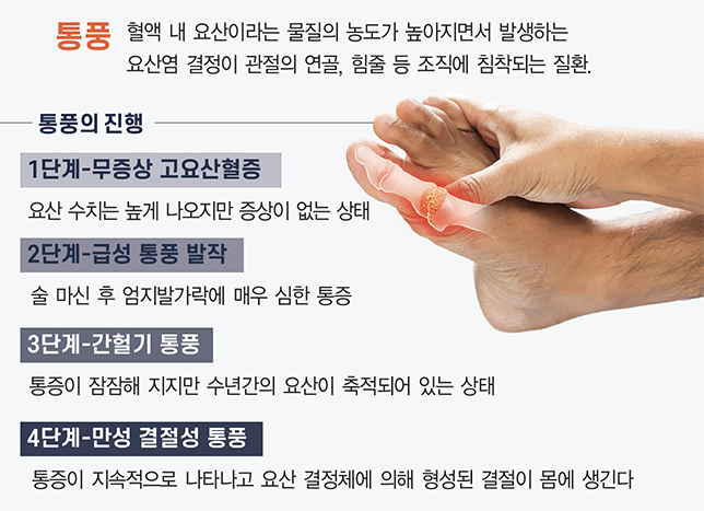 통풍 초기증상