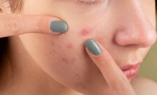 좁쌀여드름-없애는-방법