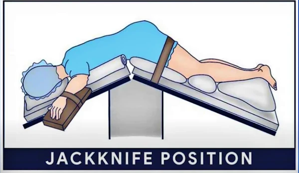 치질 수술 자세 중 하나로 잭 나이프 자세