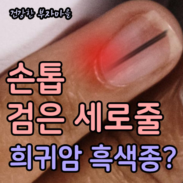 손톱_검은_세로줄