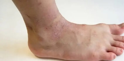 아토피피부염-정의-원인-증상-치료방법-생활습관