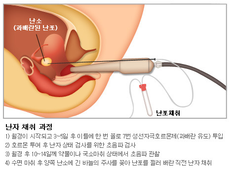 난자 채취 과정