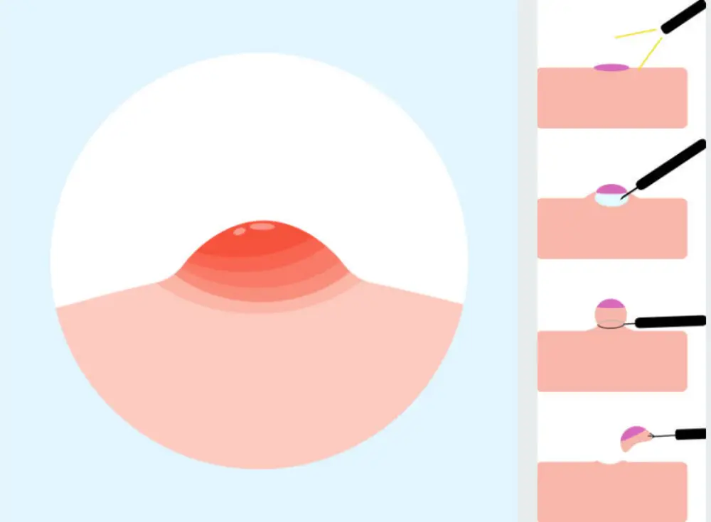 피지낭종 제거