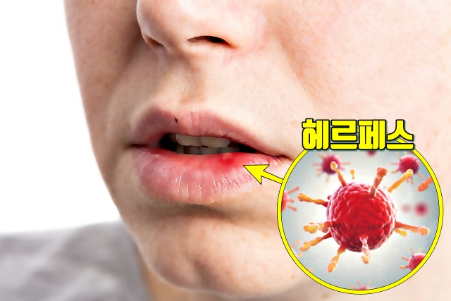면역력이 떨어졌을때 증상 입술 물집 헤르페스 면역력 저하 증상, 건강 팁줌 매일꿀정보