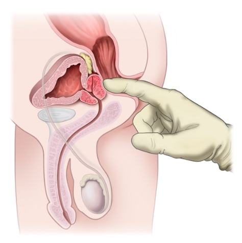 직장 수지 검사