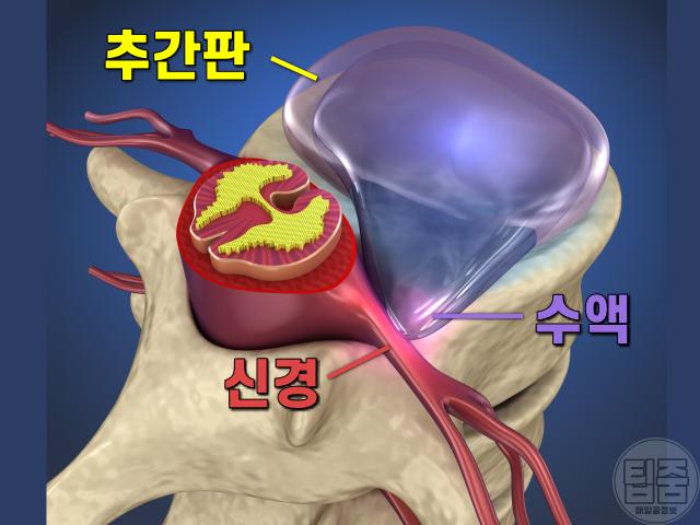목디스크 증상 자가진단,팁줌