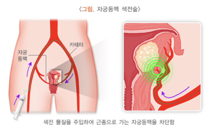 자궁동맥 색전술