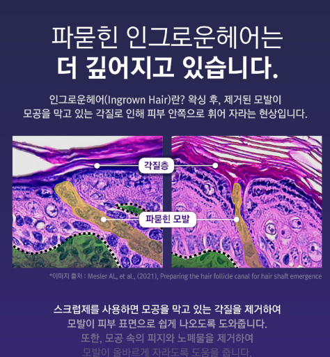 효과! 인그로운헤어 확실히 줄었어요 