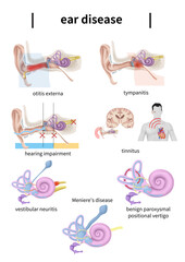 메니에르병 전정기관, 달팽이관 기능장애로 발생한다.