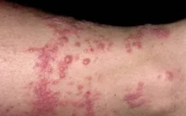 습진의 대표적인 증상