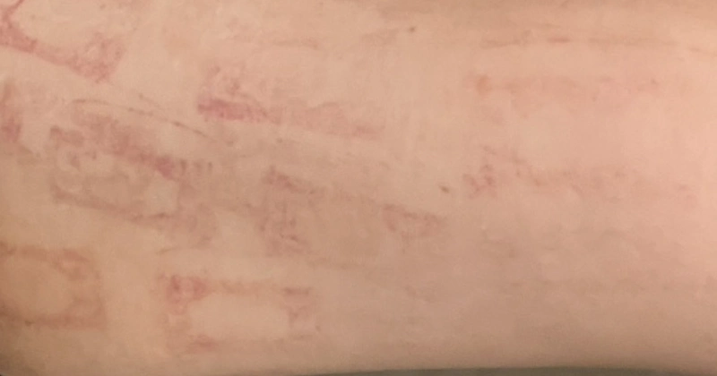 메디큐브 에이지알 바디샷 자국