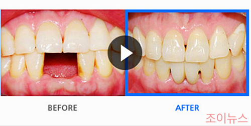 브릿지 치료 전, 후