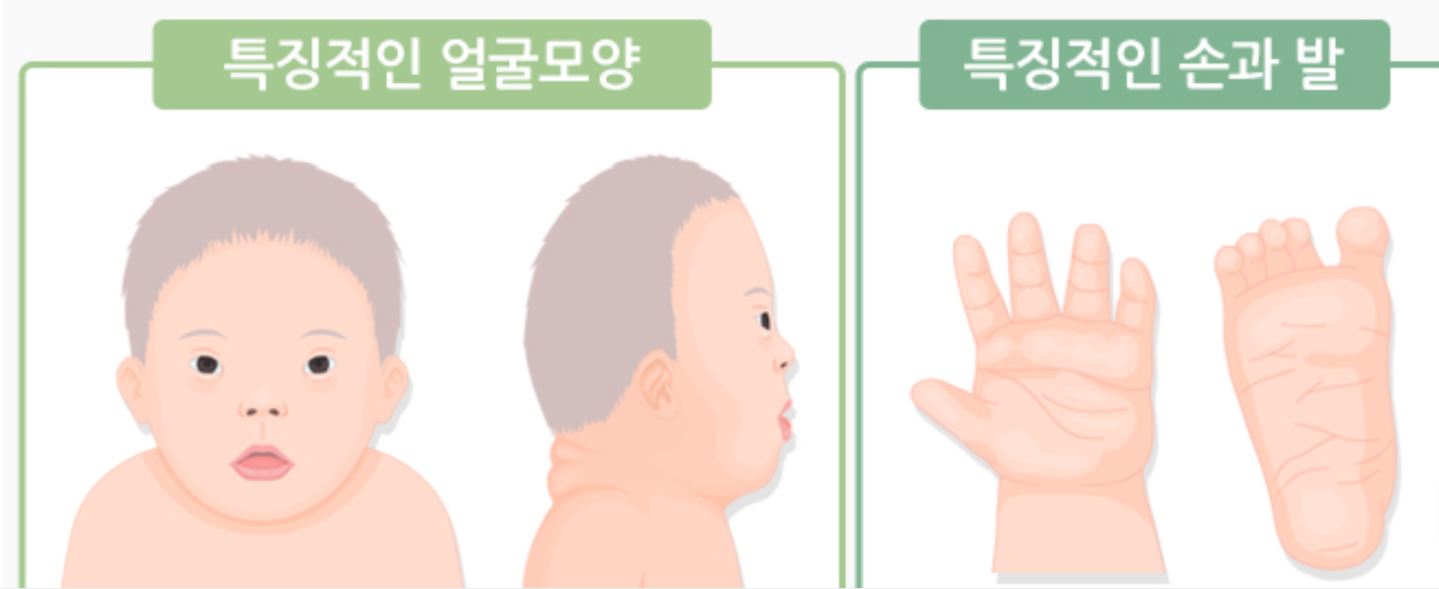 다운증후군 원인부터 증상&middot;치료까지