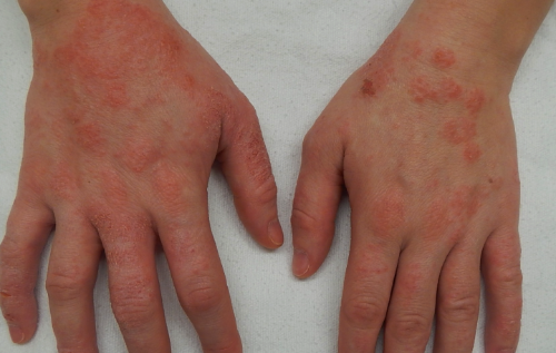 손의-피부염